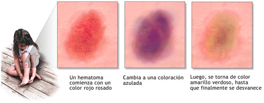 Hematoma