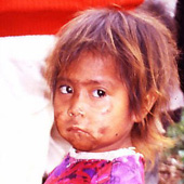 Niña con síndrome Kwashiorkor